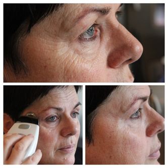 Før og etter-bilder av galvanisk behandling rundt øyet. Fine smilerynker er blitt mindre synlige.